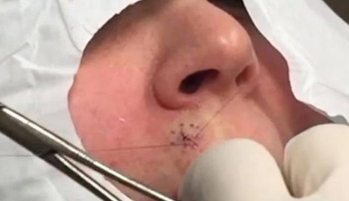 Δείτε τι αφαίρεσε χειρουργός πάνω από το χείλος της και ΦΡΙΚΑΡΕ! (Βίντεο)
