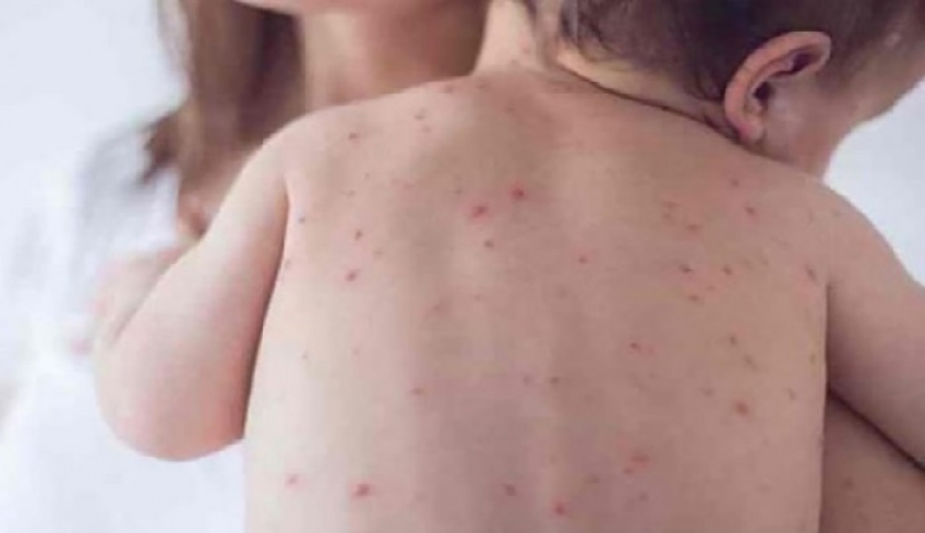 Πανευρωπαϊκός συναγερμός για την ιλαρά: Σε υψηλό 20ετιας τα κρούσματα λόγω του κινήματος κατά των εμβολίων
