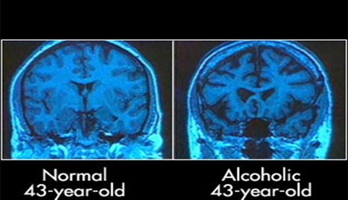 Τι παθαίνει ο εγκέφαλος σου όταν πίνεις αλκοόλ;