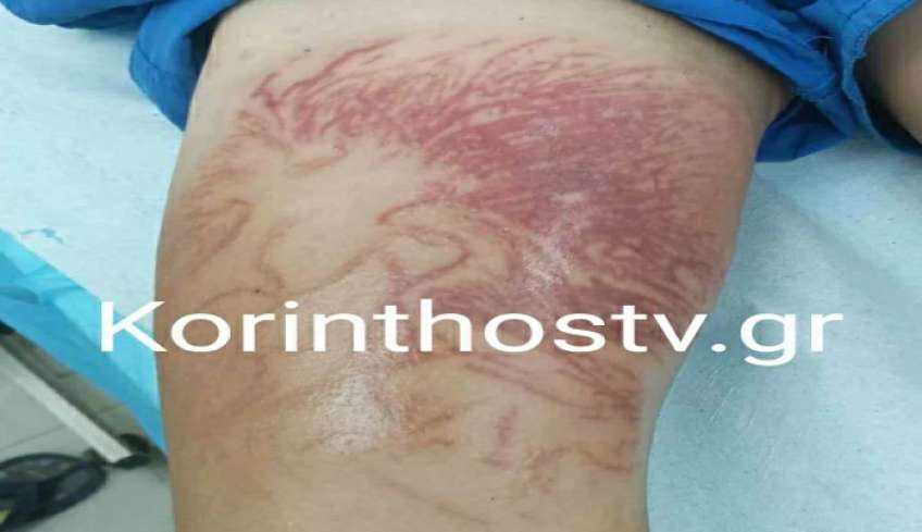 Θαλάσσια ανεμώνη τσίμπησε 9χρονο στην Κόρινθο, μεταφέρθηκε στο νοσοκομείο