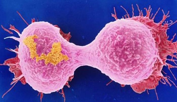Στα γονίδια η απάντηση για την επανεμφάνιση του καρκίνου του μαστού
