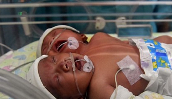 Γεννήθηκε μωρό με δύο κεφάλια στην Ινδονησία [εικόνες-βίντεο]