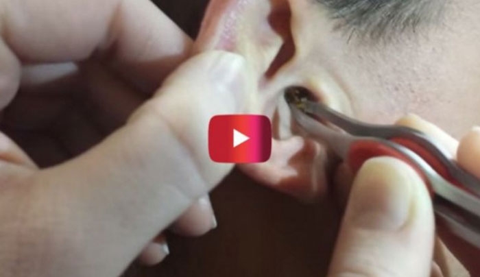 Η ποσότητα κεριού που αφαίρεσαν από το αυτί του τύπου είναι απλά ΑΗΔΙΑΣΤΙΚΗ! (Βίντεο)