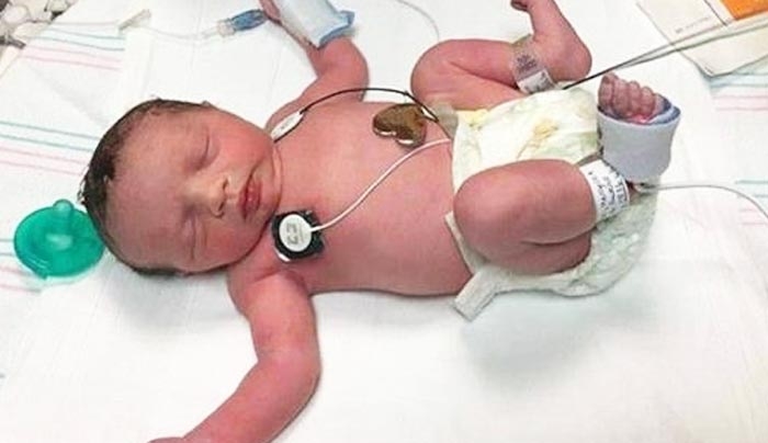 Ιατρικό θαύμα: Αυτό είναι το μωρό που γεννήθηκε 2 φορές (βίντεο)