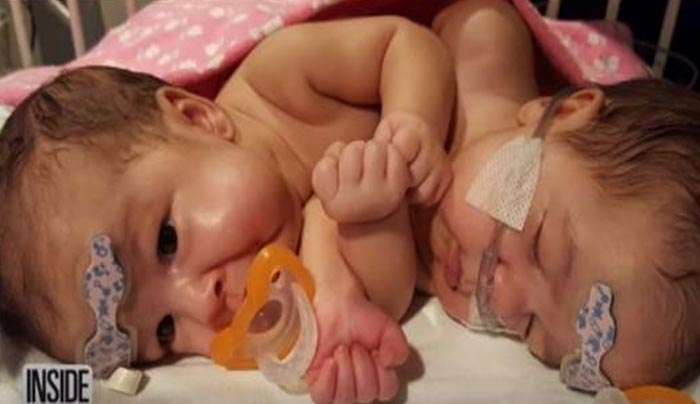 Σιαμαία μωρά επιβιώνουν μετά τον διαχωρισμό τους - ΒΙΝΤΕΟ