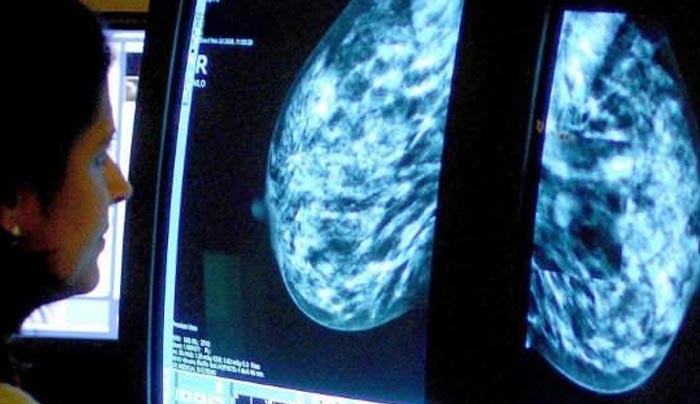 Σπουδαία ανακάλυψη: Συνδυασμός φαρμάκων συρρίκνωσε θεαματικά καρκίνο του μαστού σε 11 μέρες