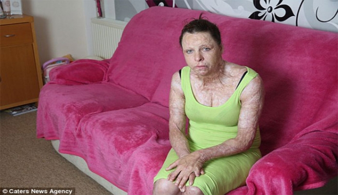 Σκληρές Εικόνες!! «Πέθανα 3 φορές και επανήλθα, ήμουν 5 μήνες σε κώμα και τώρα μοιάζω με τέρας»