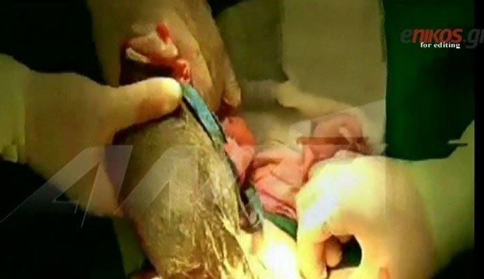 Γιατρός του Παίδων Πεντέλης έσωσε από το θάνατο μία 8χρονη που έτρωγε τα μαλλιά της - ΒΙΝΤΕΟ