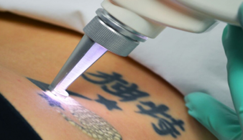 Η νέα πρωτοποριακή μέθοδος για την αφαίρεση τατουάζ με λέιζερ