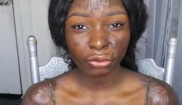 Συγκλονίζει η blogger που κάηκε στο πρόσωπο και ανεβάζει βίντεο με μακιγιάζ! (Βίντεο)