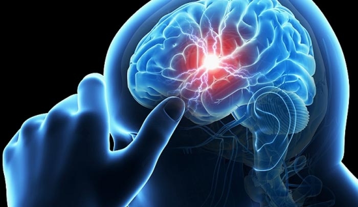 Εγκεφαλικό: Πώς εκδηλώνεται και πώς μπορείτε να το προλάβετε