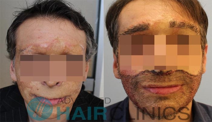 ΝΕΟ πρόσωπο σε 34χρονο δημιούργησαν Έλληνες επιστήμονες