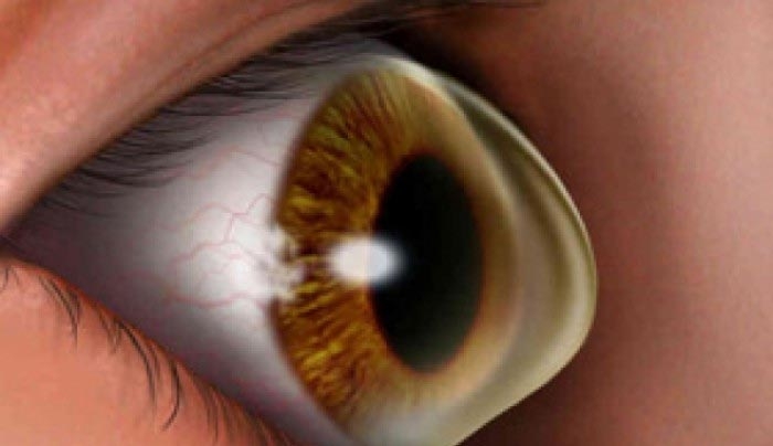 Κερατόκωνος: Ποιοι κινδυνεύουν περισσότερο από την οφθαλμική διαταραχή