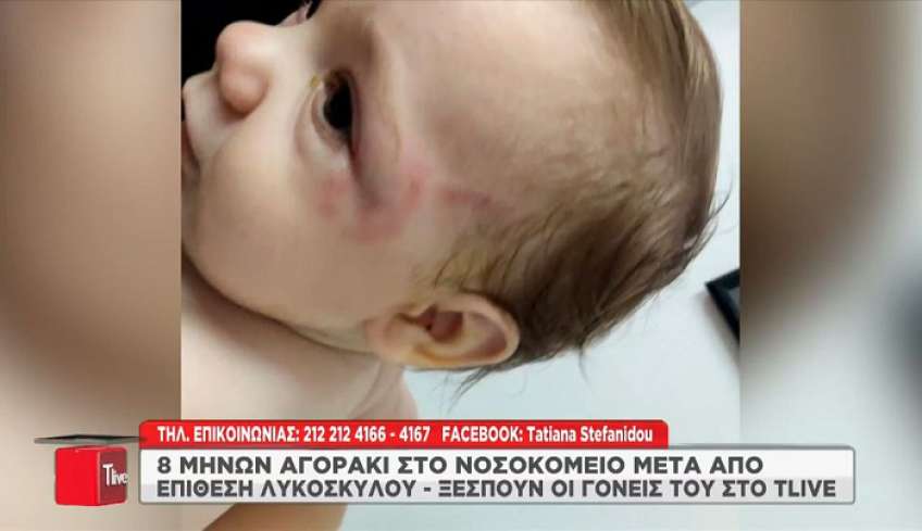 Κρήτη: «Γροθιά στο στομάχι» οι εικόνες του βρέφους το οποίο δάγκωσε ο σκύλος - Συγκλονίζει ο πατέρας