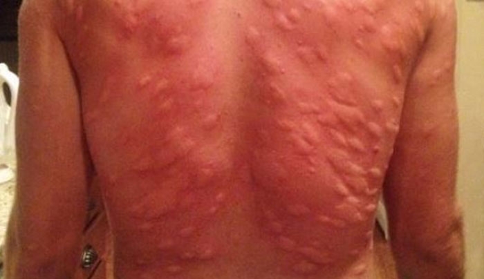 ΣΟΚ από την ομαδική επίθεση κουνουπιών “αλλοίωσε” την πλάτη του! (Φωτό)